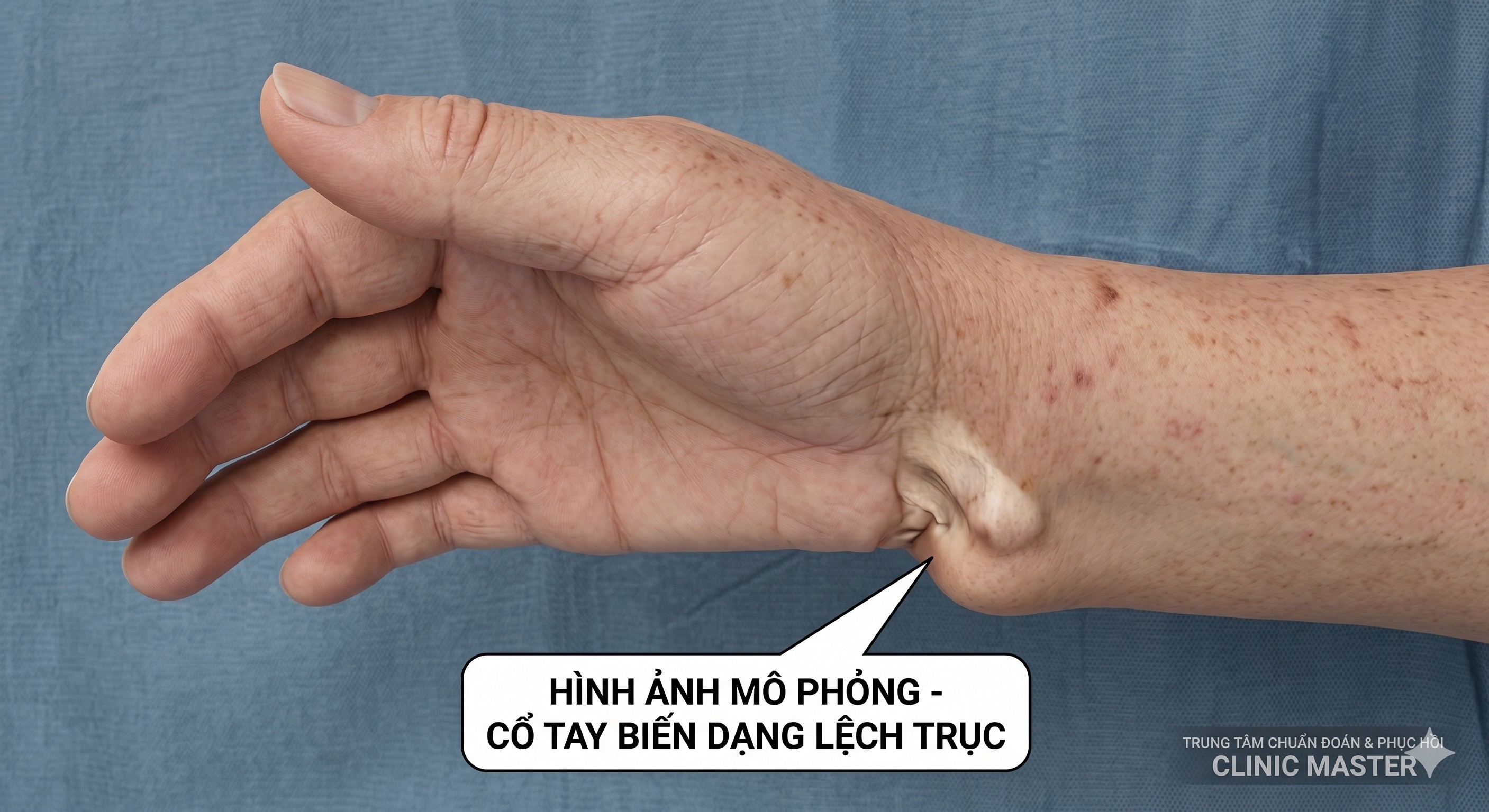 Triệu chứng gãy xương