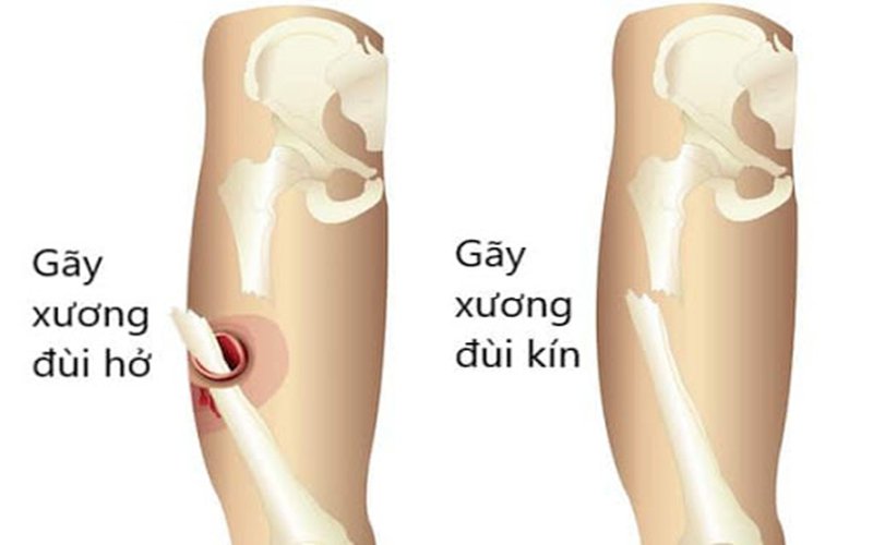 Đại cương gãy xương