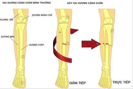 dai-cuong-gay-xuong-khai-niem-phan-loai-va-nguyen-tac-dieu-tri