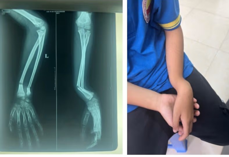 Dấu hiệu gãy xương kín