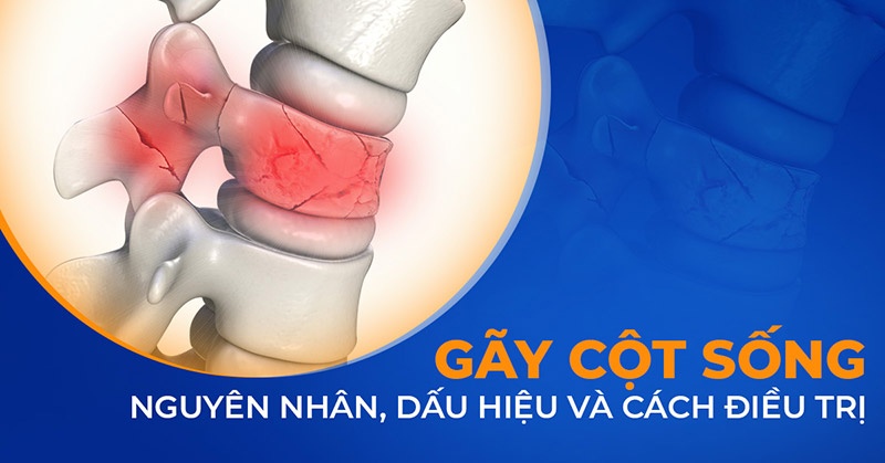 Gãy xương sống