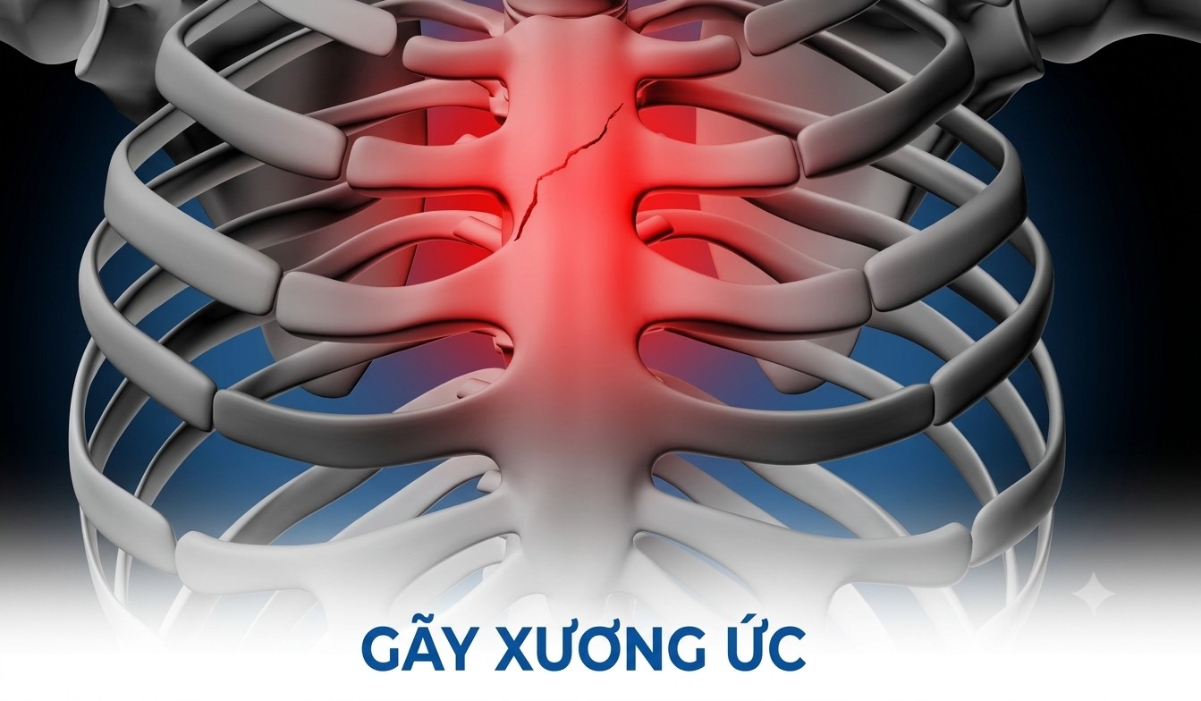 Gãy xương ức