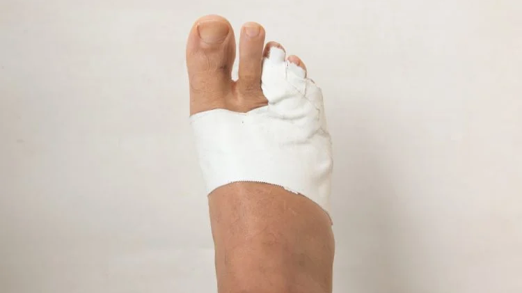 Gãy xương bàn chân số 5 bó bột bao lâu