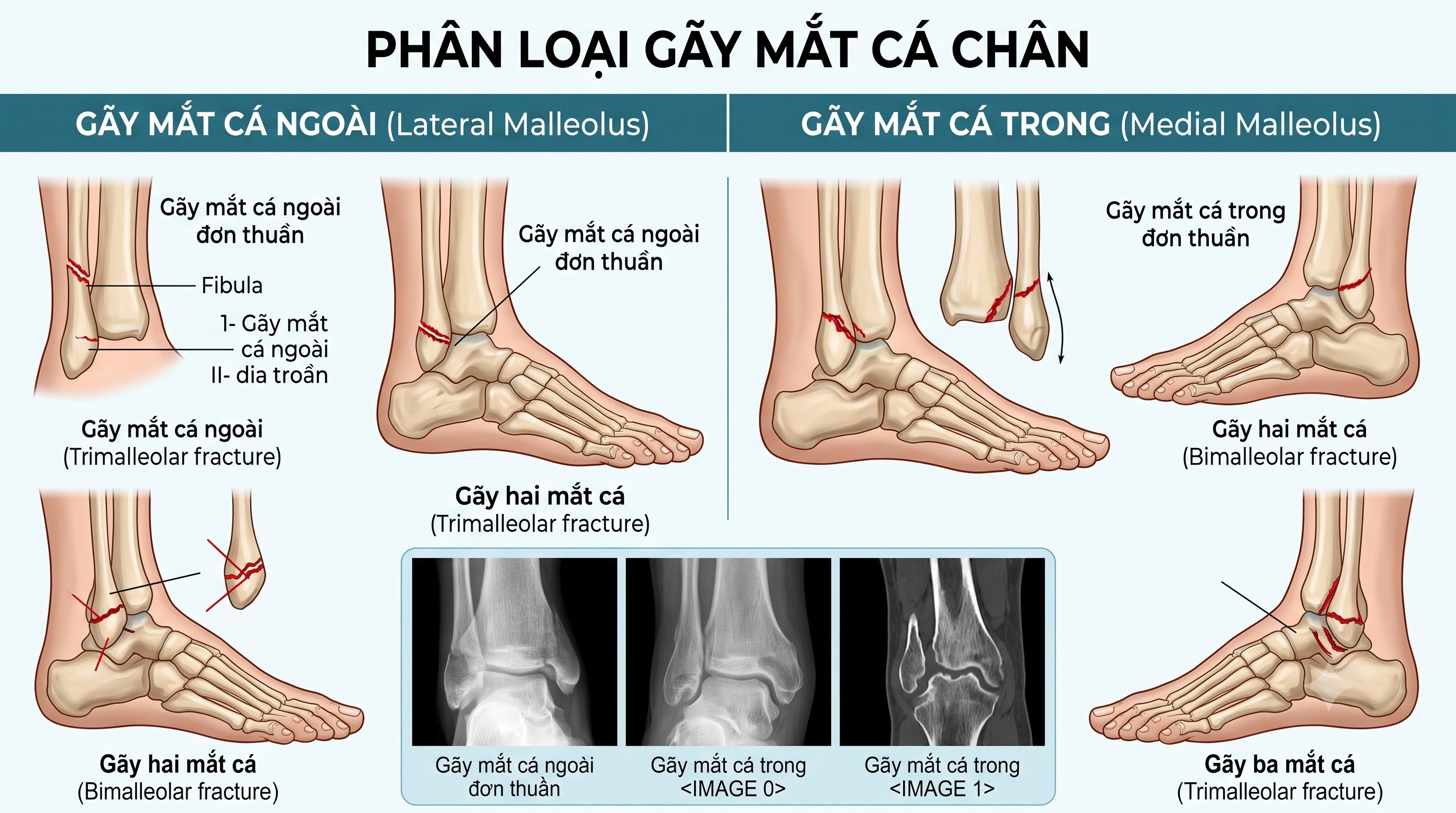 phân loại gãy xương mắt cá chân