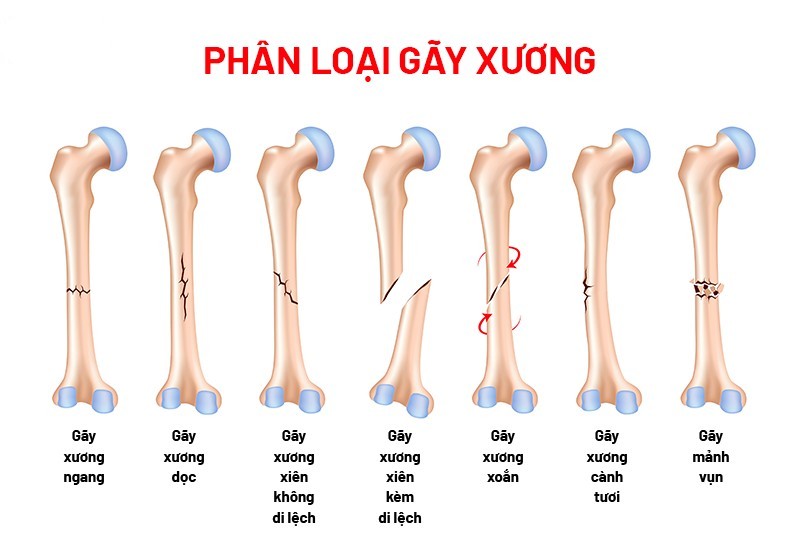 Phân loại gãy xương là gì