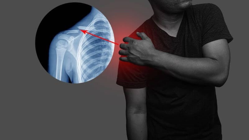 Gãy Xương Vai: Dấu Hiệu, Phân Loại Và Phác Đồ Điều Trị Phục Hồi Chuyên Sâu